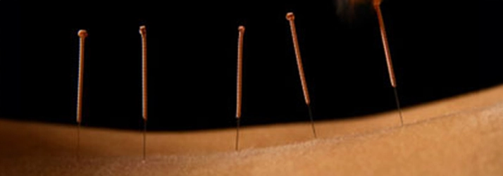 Chiropractic Woodlawn MD Dry Needling On Back